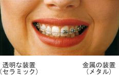 歯の表側（唇側、頬側）につける矯正装置の種類