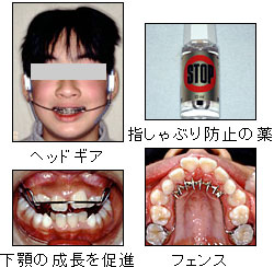 臼歯交叉咬合の改善