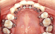 歯の裏側からの矯正